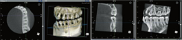 歯科用CT