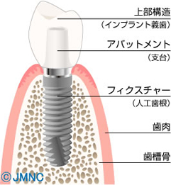 インプラント