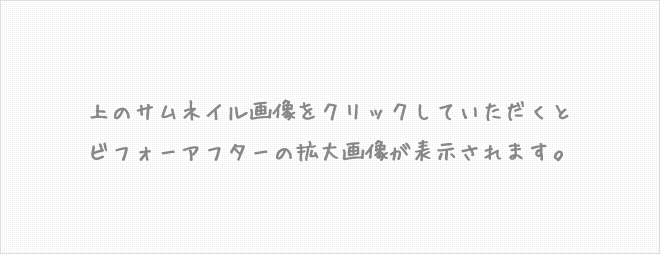 インビザライン：上顎前突 症例１