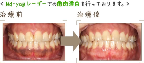 歯科用CT